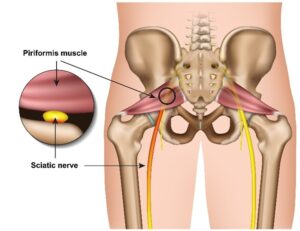 piriformis pressing on sciatic nerve